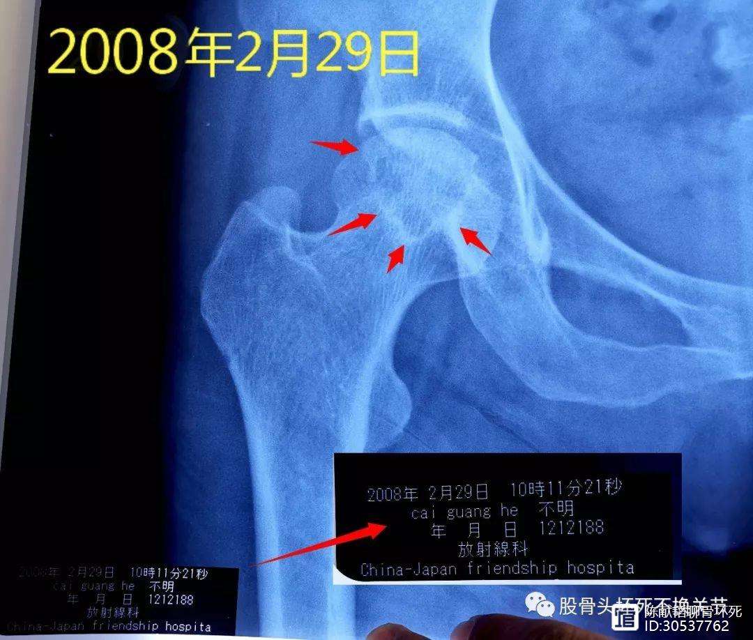 新乡人工骨头医保报销多少(人工骨头医保报销多少比例)
